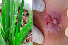 Aloe per il trattamento delle emorroidi